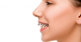 How to fix an overbite with braces